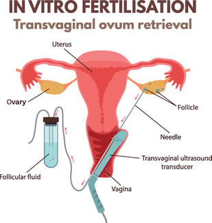 transvaginal ovum retrieval