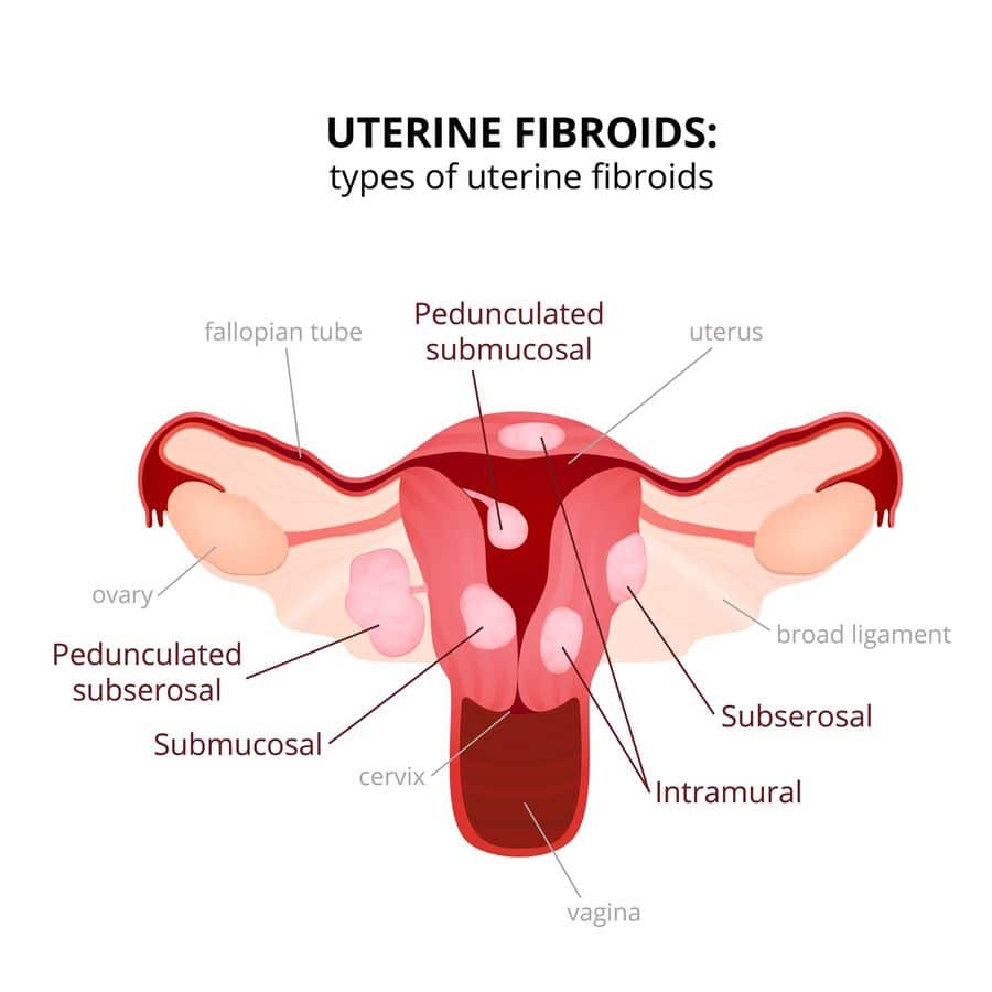 uterine fibroids 