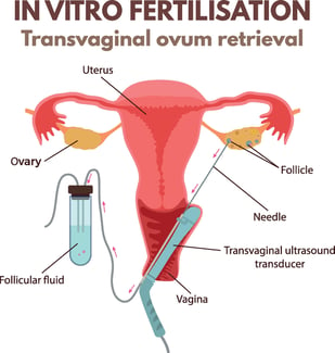 transvaginal-ovum-retrieval-graphic