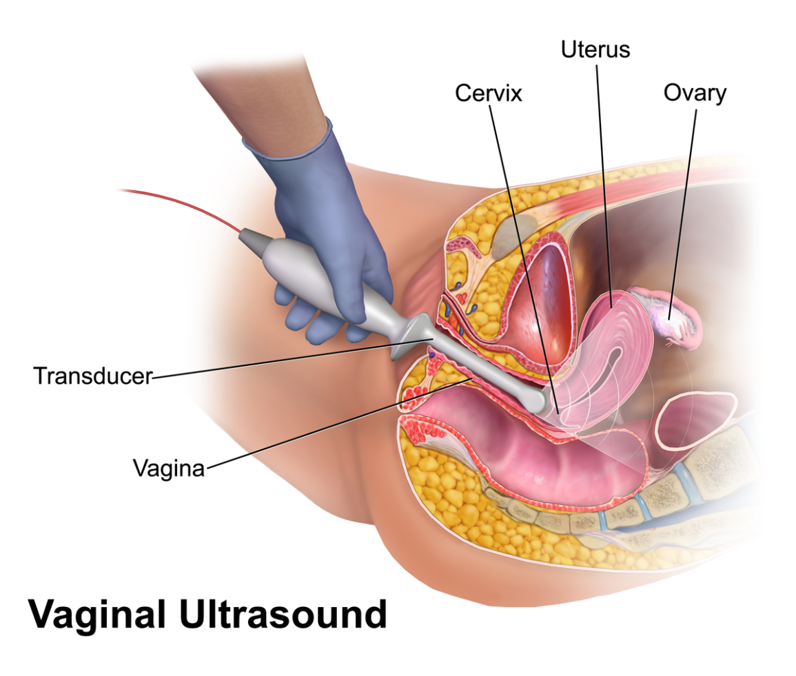 vaginal ultrasound ivf 