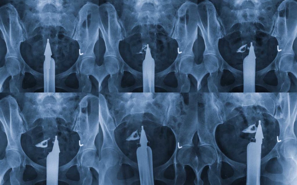 Hysterosalpingogram Female Infertility Testing Clinic PFCLA